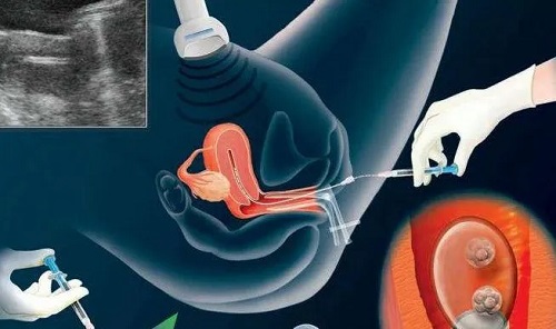 美国试管婴儿专家解读：什么胚胎等级可以达到移植标准？
